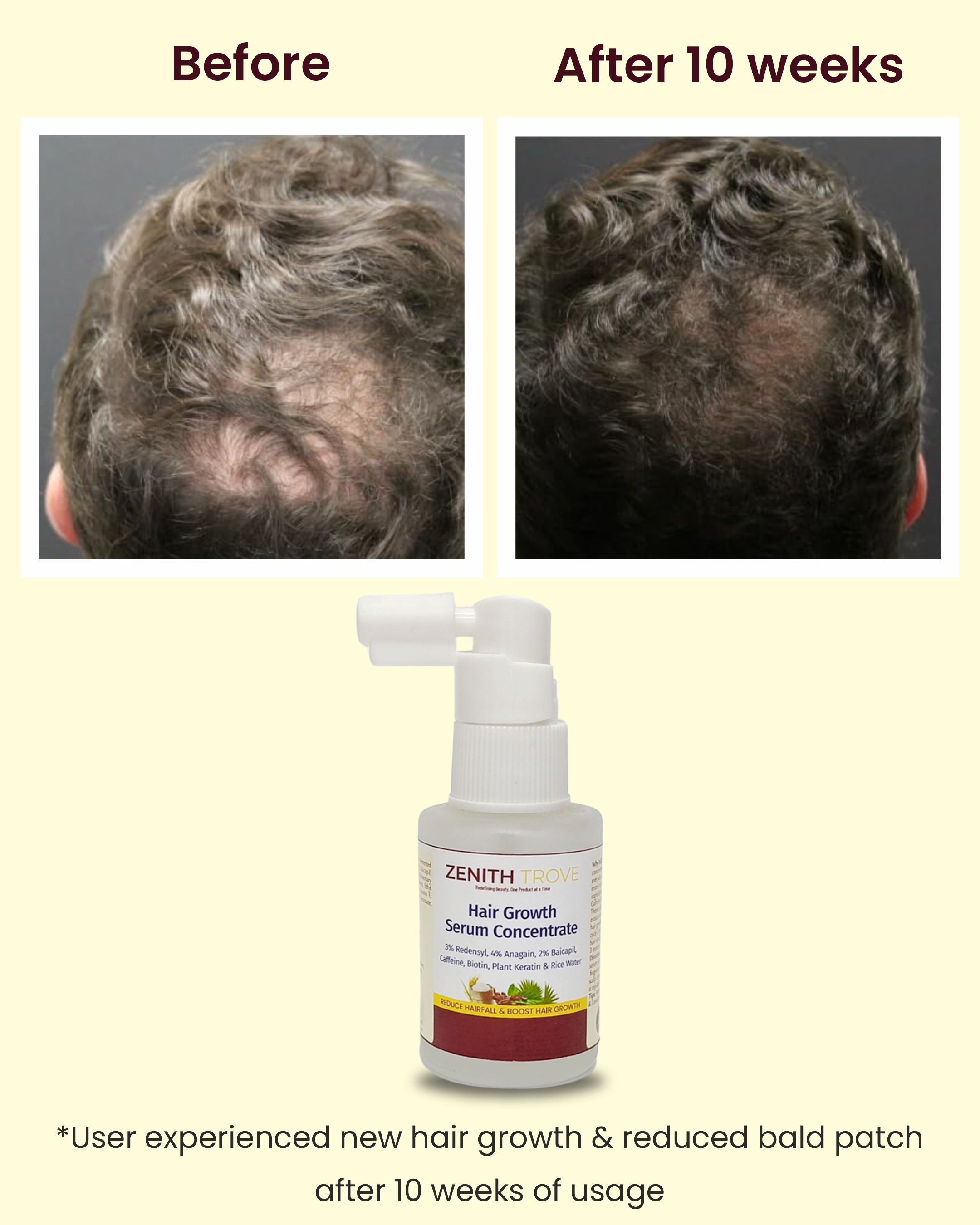 zenith trove advanced hair growth serum 3 redensyl 4 anagain 2 baicapil with caffeine biotin and rice water 